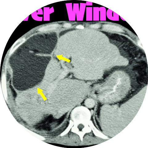 Liver Window