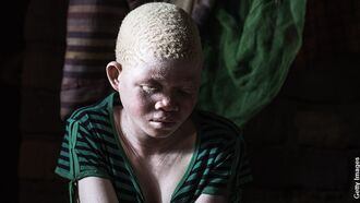 Brazen Criminal Gangs Targeting Albinos in Malawi