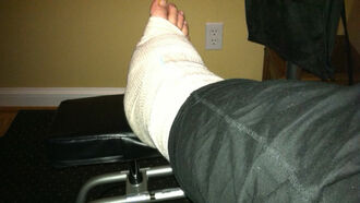 Ian's Post-Surgery Ankle