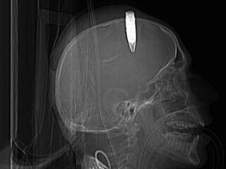 Surgeons Remove Explosive from Soldier's Head