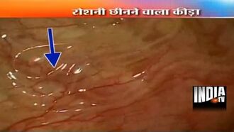 Five-Inch Worm Removed From Eye