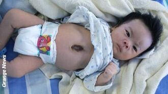 Baby Born with External Heart