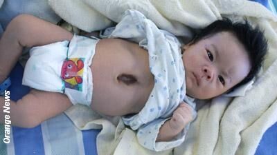 Baby Born with External Heart