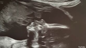 Video: Woman Believes Ultrasound Shows Her Late Father Kissing Baby