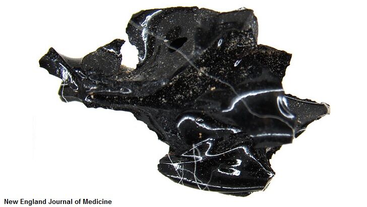 Scientists Discover Vesuvius Blast Turned Victim's Brain into Glass