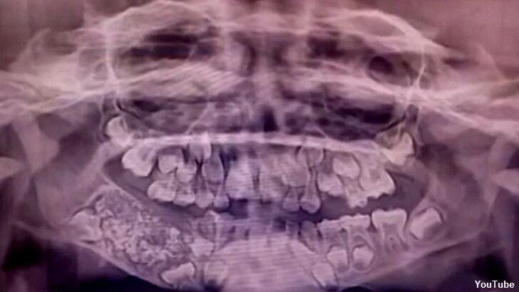 Video: Doctors in India Remove 526 Teeth From Boy's Mouth