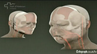 Full Face Transplant Performed