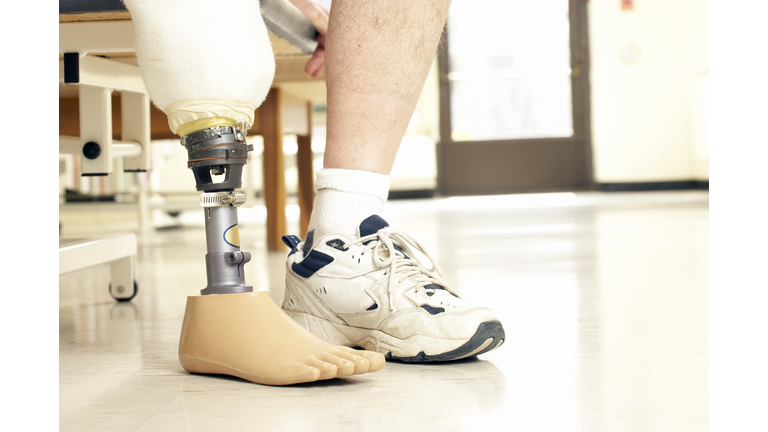 Patient using prosthetic leg
