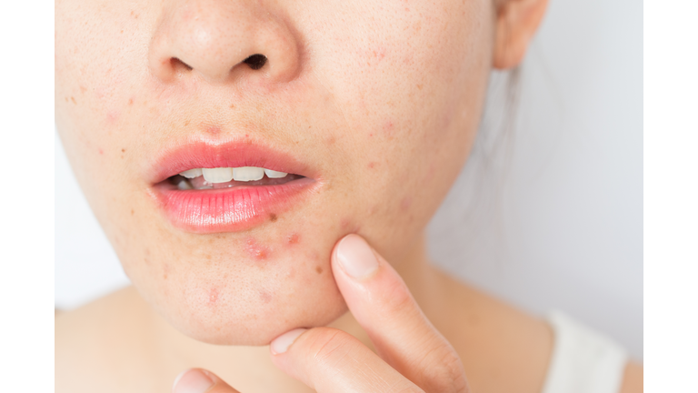 Closeup of woman half face with problems of acne inflammation (Papule and Pustule) on her face.