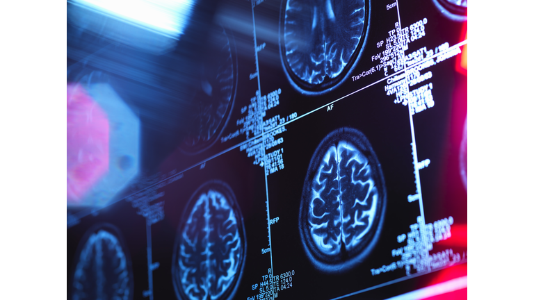 Human brain scan in a neurology clinic