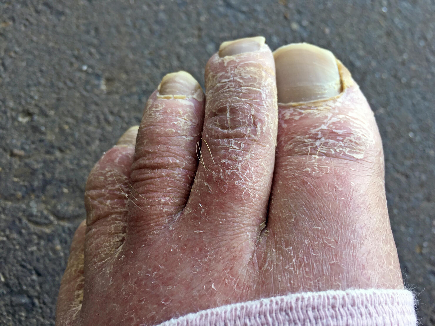 Ugly toes with dry skin