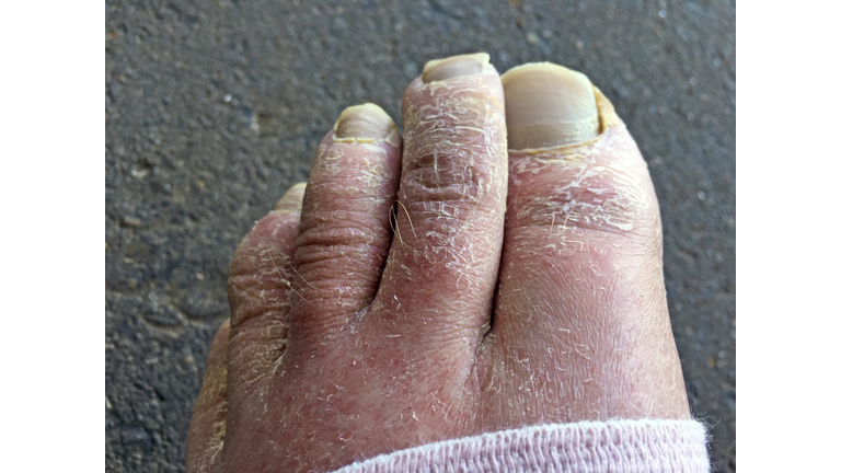 Ugly toes with dry skin