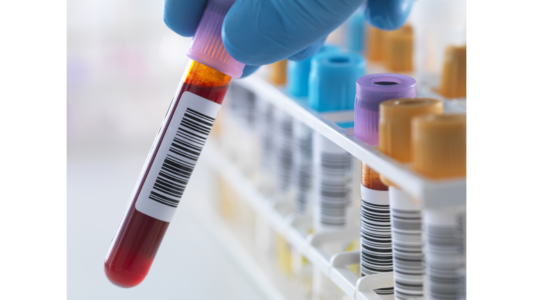 A blood sample being held with a row of human samples for analytical testing including blood, urine, chemistry, proteins, anticoagulants and HIV in lab