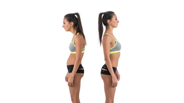 Woman with impaired posture position defect scoliosis and ideal bearing