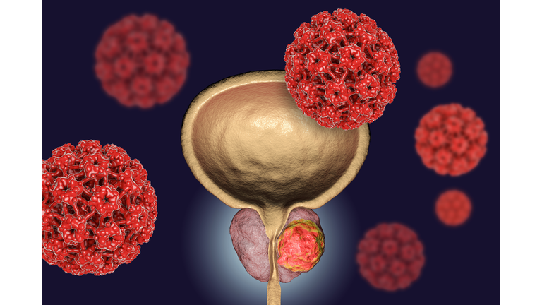 Conceptual image for viral ethiology of prostate cancer