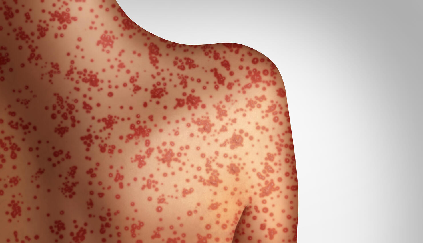 Measles Concept
