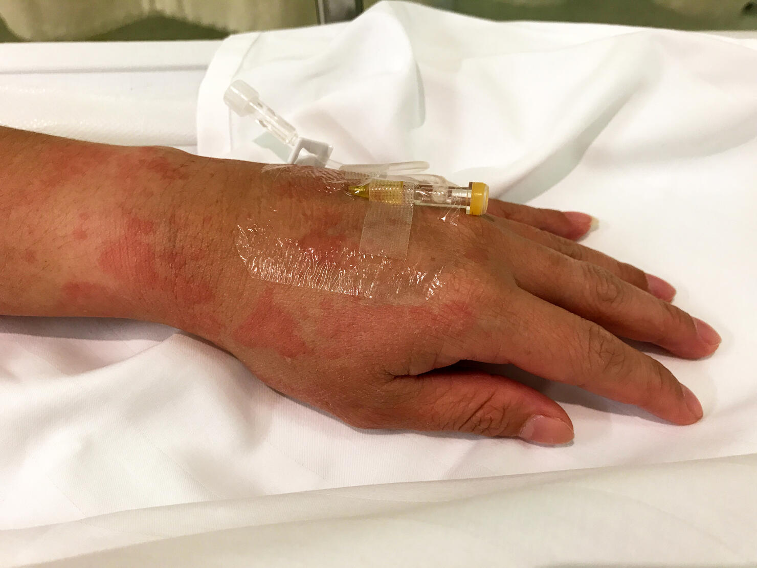 Painkiller injection for hives or urticaria; a kind of skin rash with red, raised, itchy bumps.
