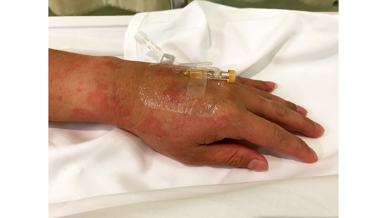 Painkiller injection for hives or urticaria; a kind of skin rash with red, raised, itchy bumps.