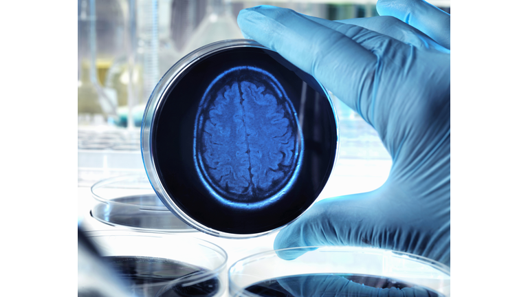 Scientist holding a petri dish with a brain scan illustrating research into dementia, alzheimers and other brain disorders.