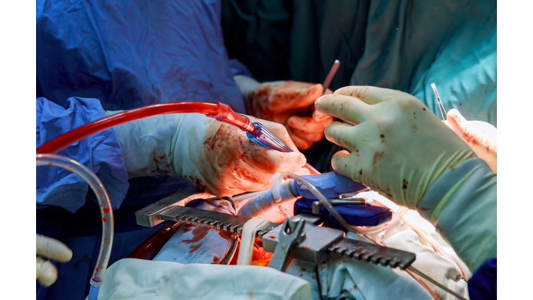 Team of surgeons using electric cautery and clamps for minithoracotomy intervention close-up, open cord heart surgery minimally invasive surgery.