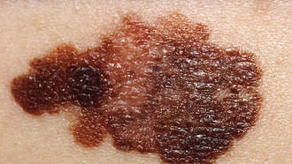 WHP580 Newsroom - Study Links Skin Cancer Cluster to Farmland in Pennsylvania