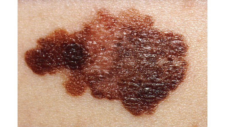 Melanoma, Skin Cancer