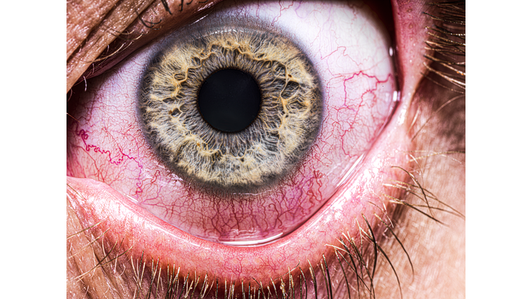 Bloodshot eye