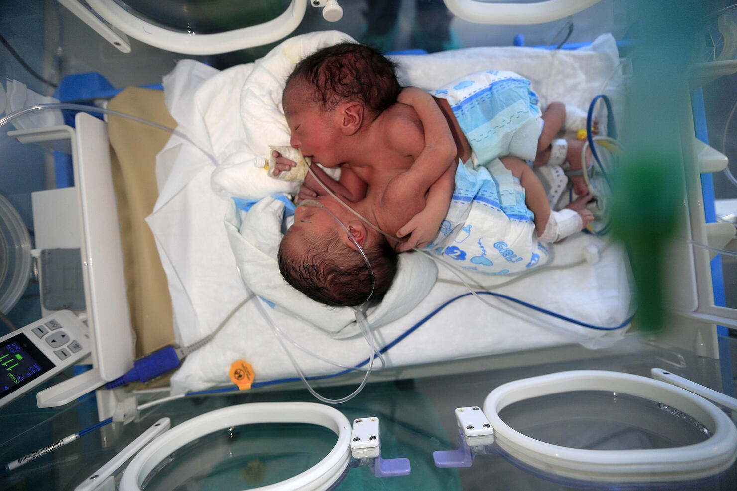 Newborn conjoined twins lie in an incubator