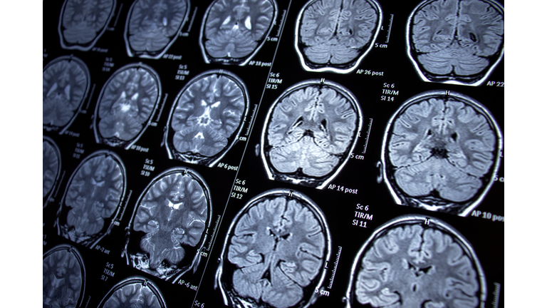 Magnetic resonance imaging - MRI - Photosensitive Epilepsy /  Seizures - Neurological Diseases