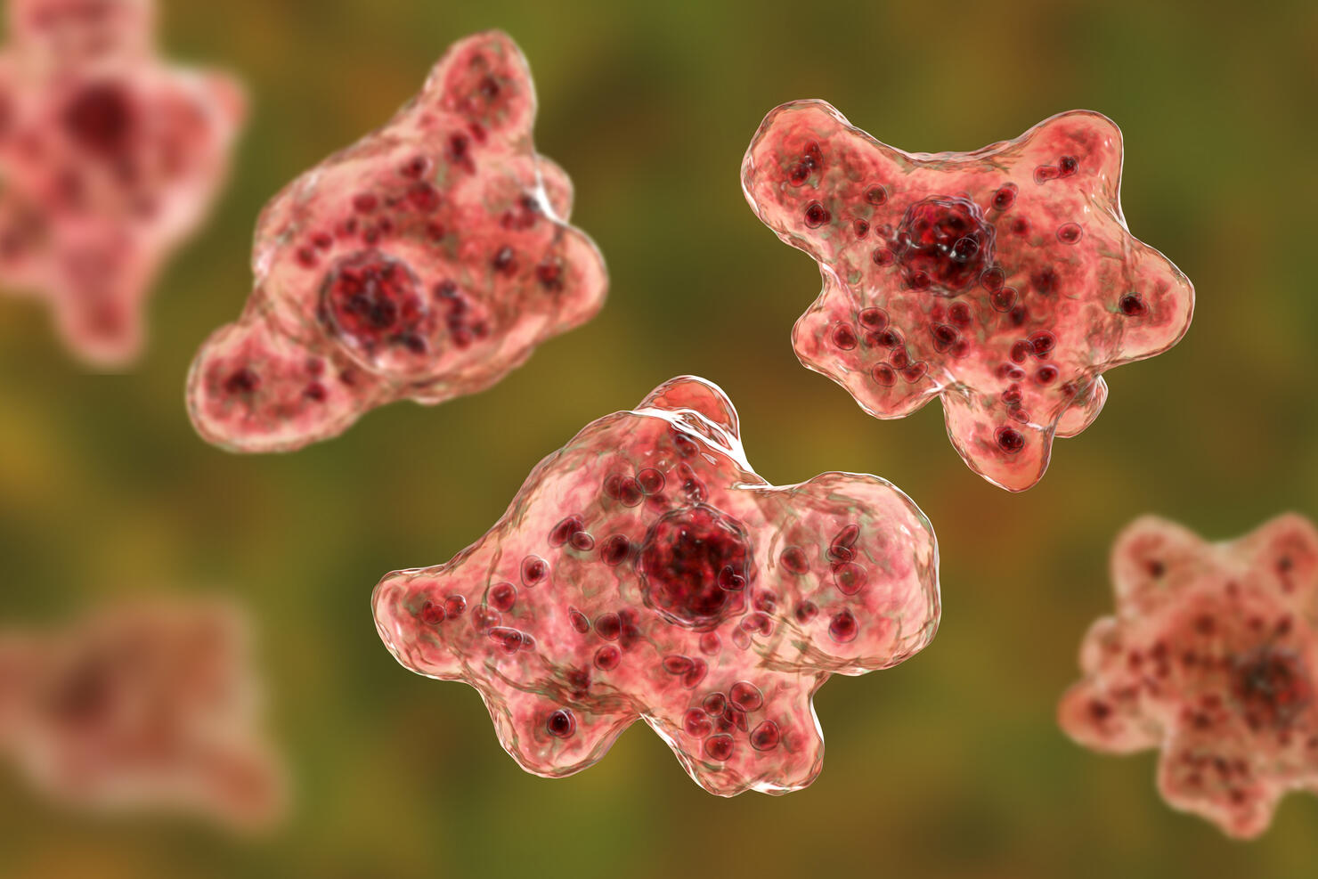 Brain-eating amoeba infection, naegleriasis