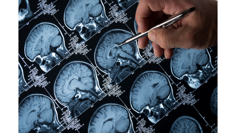 MRI Brain Scan of head and skull with hand pointing