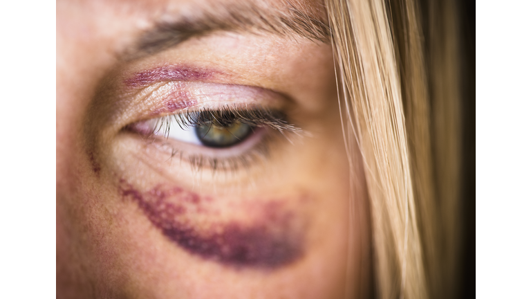 USA, New Jersey, Jersey City, Portrait of woman with black eye