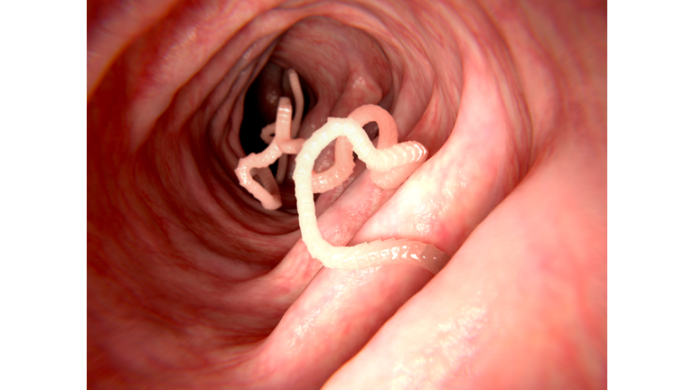 Tapeworm in human intestine