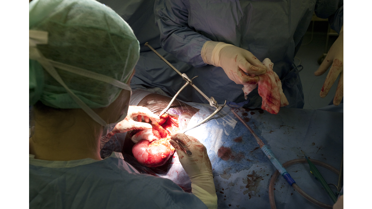 Kidney transplant operation