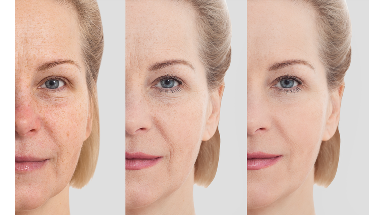 Face without makeup. Middle age close up woman face before after cosmetic. Skin care for wrinkled face. Before-after anti-aging facelift treatment. Facial skincare and contouring.