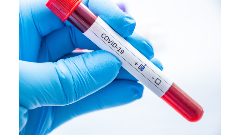 Laboratory technician, medical specialist, doctor or scientist holds blood test tube in his hand, where coVID-19 is written and positive result of analysis for coronavirus is shown to camera close-up