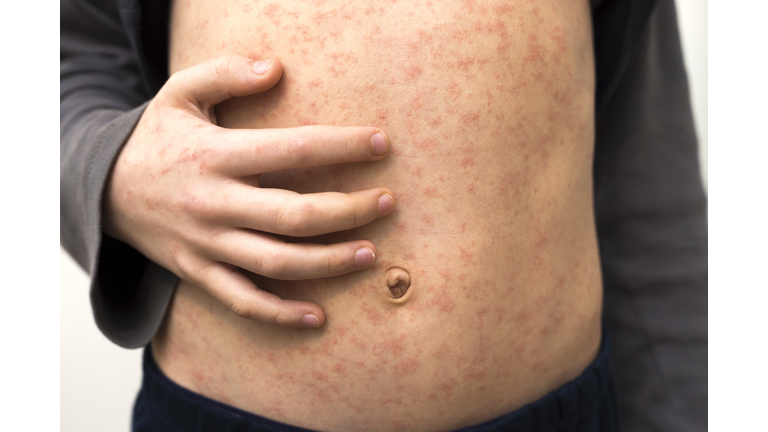 Sick child with red rash spots from measles.