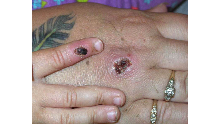 Monkey Pox Lesions 