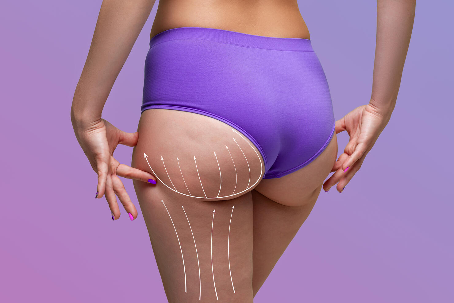 Buttocks liposuction, fat and cellulite removal concept, overweight female body with painted surgical lines and arrows
