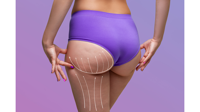 Buttocks liposuction, fat and cellulite removal concept, overweight female body with painted surgical lines and arrows