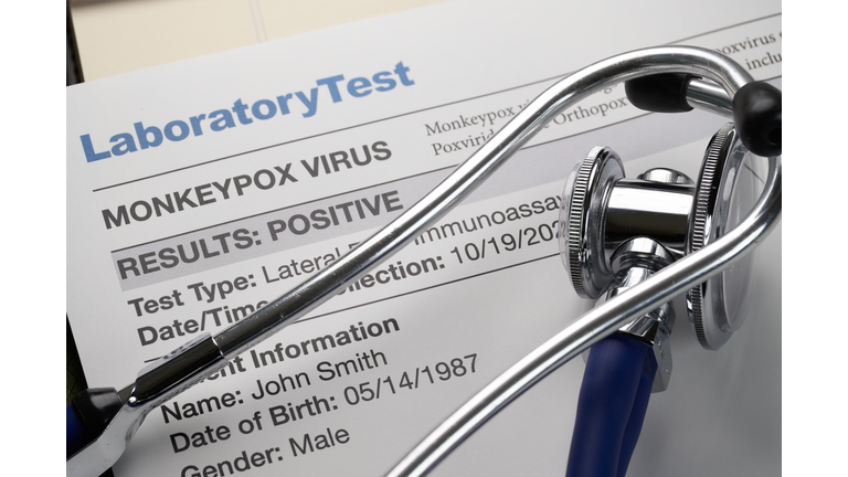 Monkeypox virus test results document with stethoscope