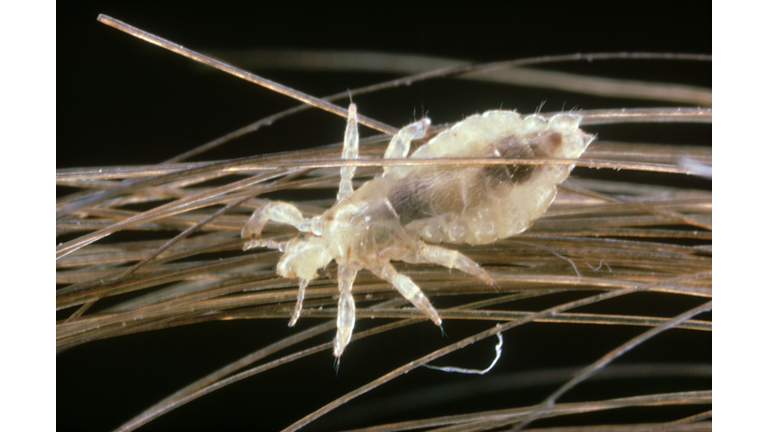 human head louse: pediculus humanus  on hair