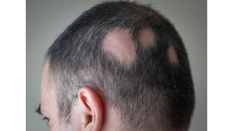 Alopecia Aerata - Spot Baldness