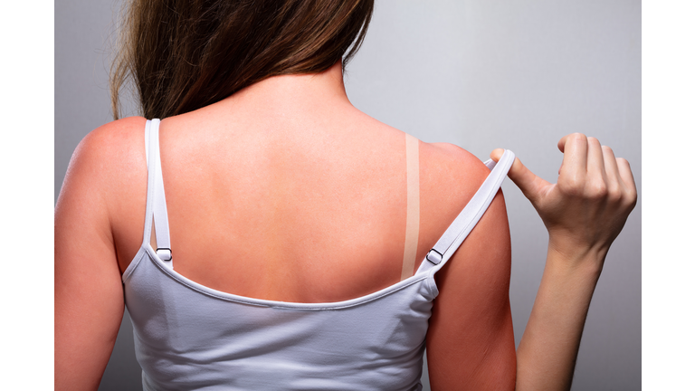 Woman with sunburn