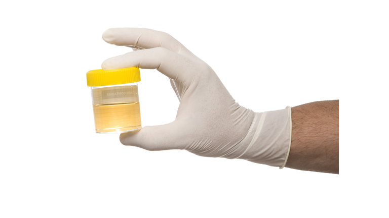 Hand wearing a rubber glove to hold a urine sample
