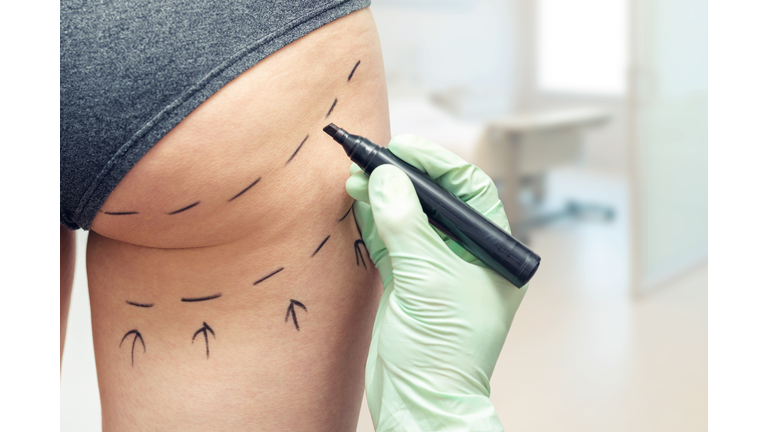 plastic surgeon marking womans body for plastic surgery