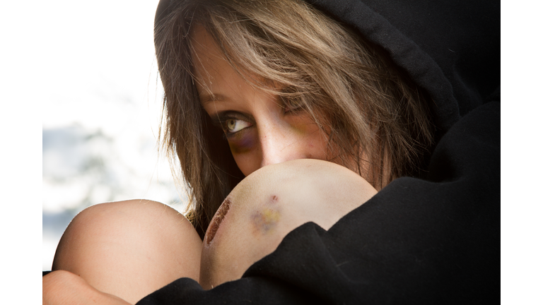 Sad Young Caucasian Woman at Great Risk with Black Eye