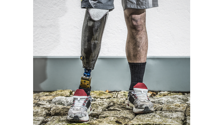 Man with prosthetic leg