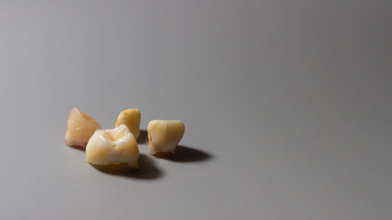 A child's lost baby tooth with traces of caries on a gray background