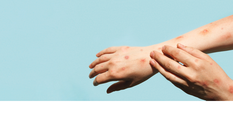 Monkeypox new disease dangerous over the world. Hands with Monkey Pox. Painful rash, red spots blisters on the hand. Close up rash, human hands with Health problem. Banner, copy space.